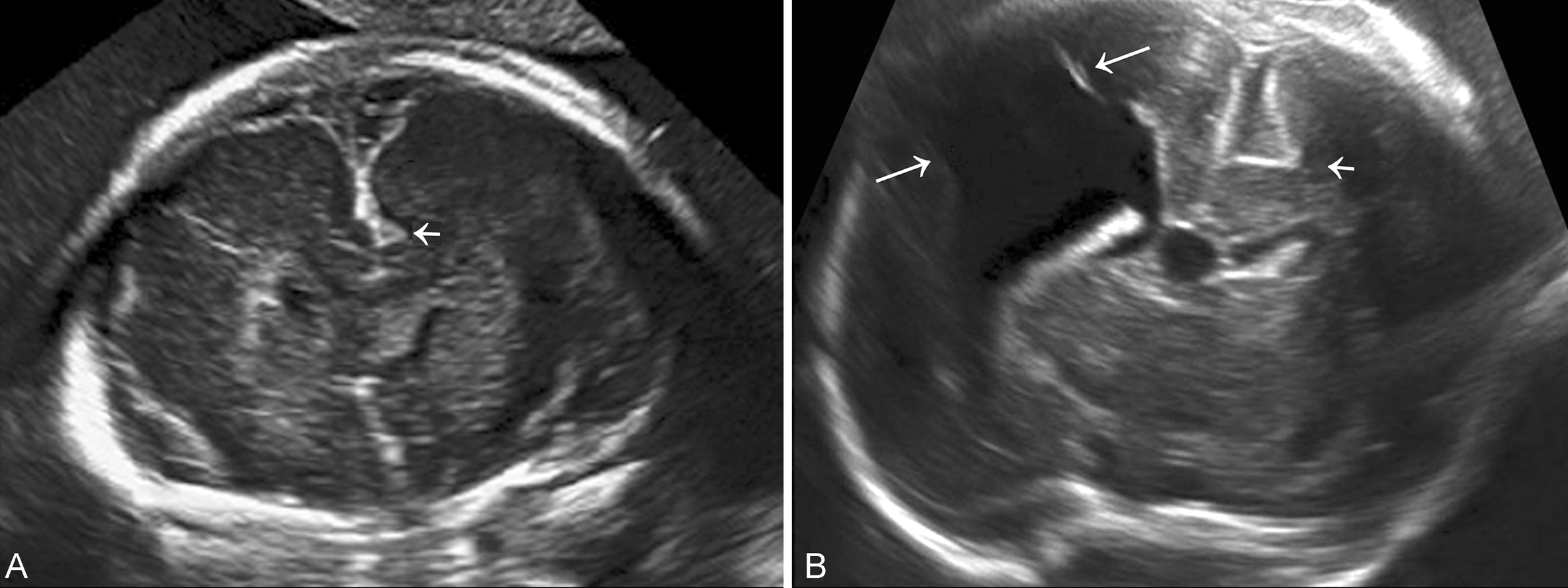 明明白白做b超,超声提示宫内单胎头位