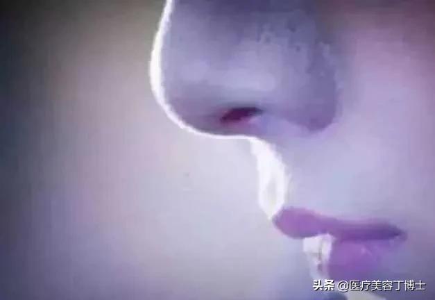 毛孔粗大皮肤又干是什么肤质,毛孔粗大的克星怎么解决