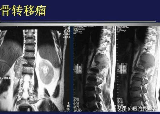 骨肿瘤能彻底治愈吗,骨肿瘤良性和恶性影像区别
