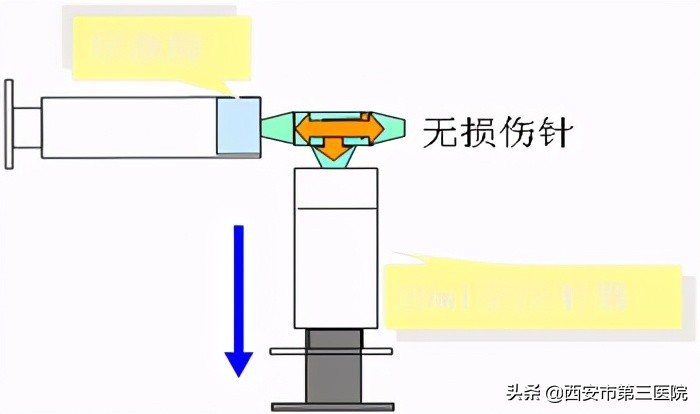 输液港堵了多久能通开,如何避免输液港堵管