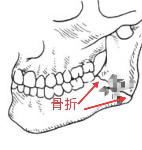 拔牙，就是简单的将牙齿扯出，真是这样吗？|口腔医生：拔牙无小事