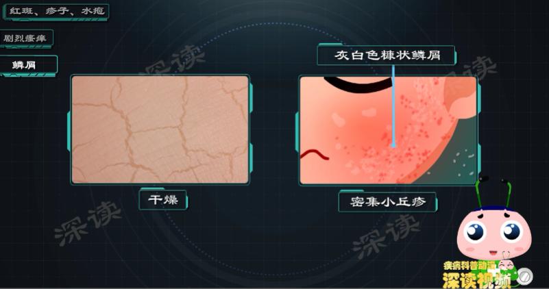 宝宝起湿疹痒不痒,宝宝起湿疹是天气热吗