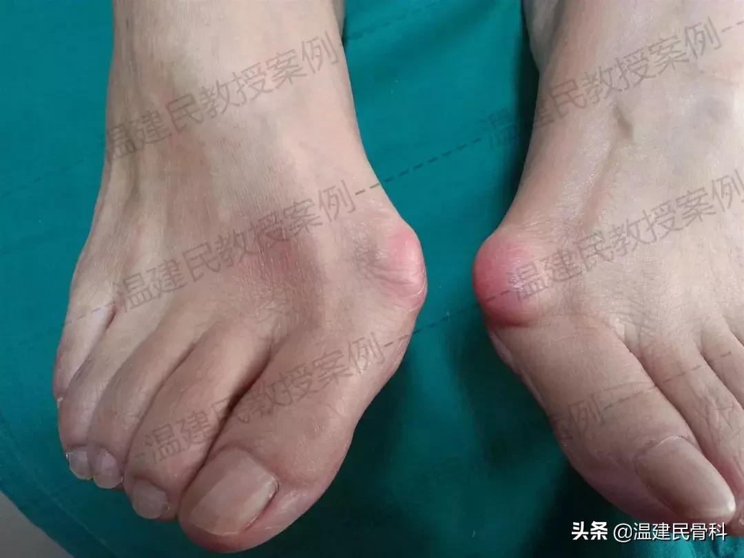 拇外翻平时走路需要注意哪些点,如何缓解拇外翻脚的痛