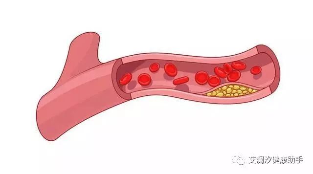 颈动脉斑块16mmx3mm有危险吗,发现颈动脉斑块需要吃药吗