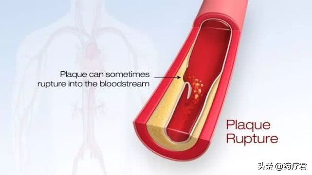 体检查出肺动脉硬化需要治疗吗,体检显示动脉硬化有斑块怎么治疗