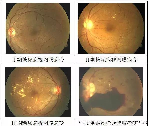糖尿病眼病能治好吗,糖尿病眼病能手术么