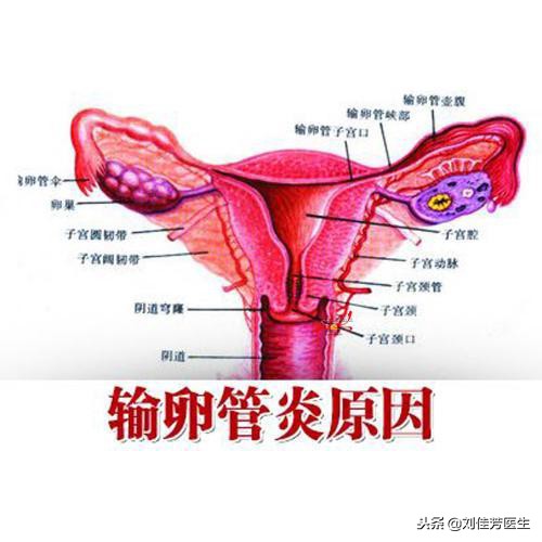 预防输卵管炎最好的方法,关于输卵管堵塞最常见的8个问题