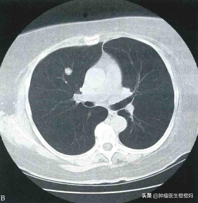 鼻咽癌转移了怎么办?医生告诫定期复查很重要,4种治疗要知道