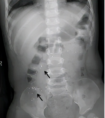小孩咬破体温计水银要洗胃吗,小狗把体温计水银咬破了怎么办