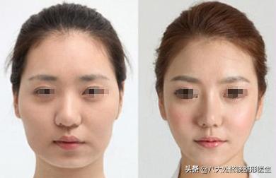 注射肉毒素脸部变化,肉毒素可以改变大小脸吗