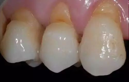 刷牙方式不对导致牙齿有条沟,错误的刷牙方式牙齿还能刷白嘛