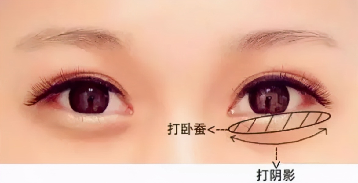 分不清泪沟眼袋印第安纹,眼袋泪沟填充好还是手术好