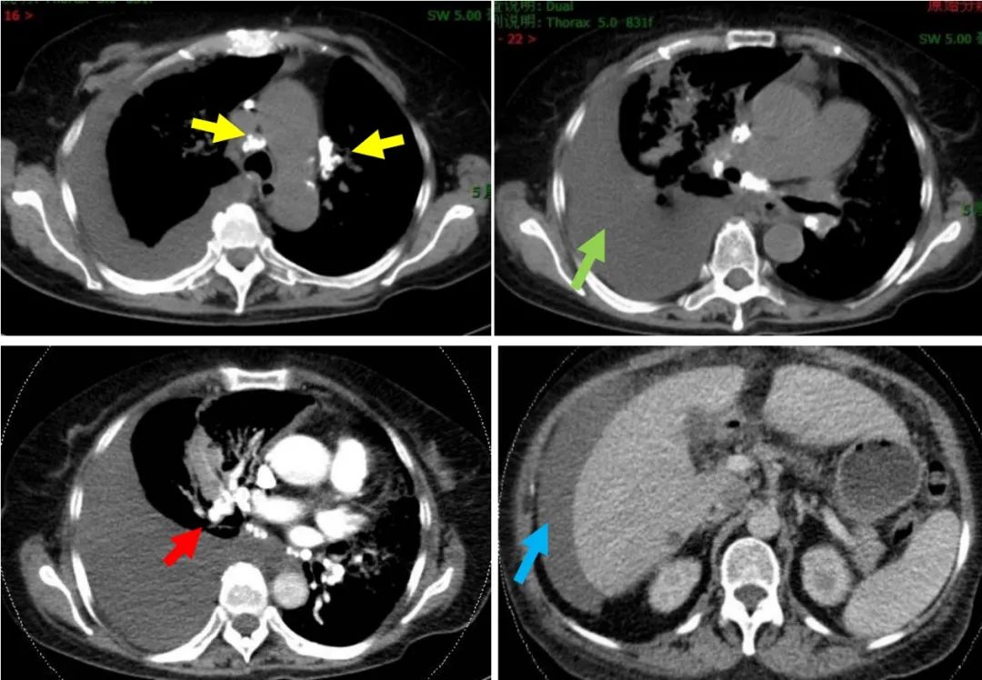 胸腔积液并有顽固性咳嗽,胸腔积液无症状