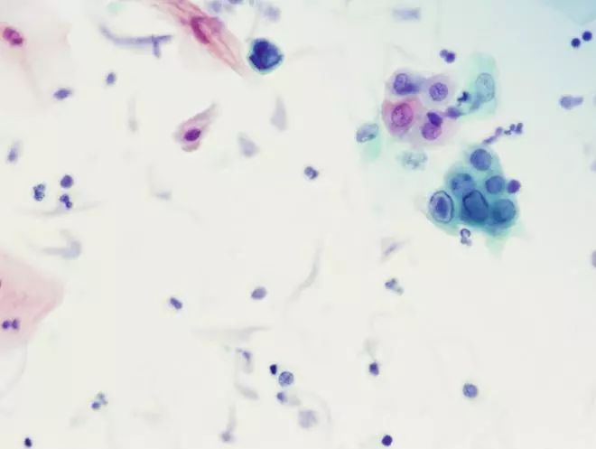 肺炎炎症图片,肺炎病历单图片