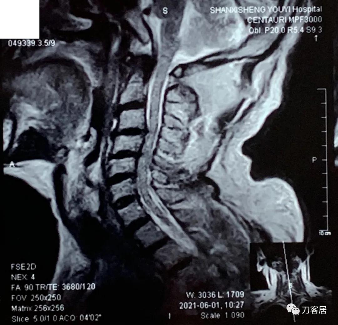 70岁男性，神经根型颈椎病，片子显示较严重，我依然先行保守治疗