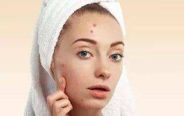 痘痘用阿达帕林多少浓度的,痘痘用阿达帕林还是夫西地酸