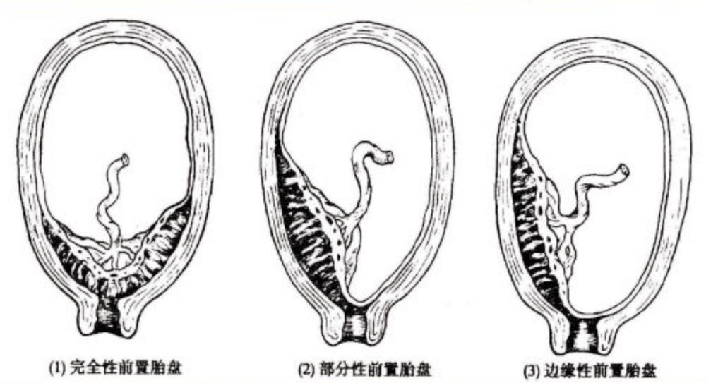 凶险性前置胎盘一般多少周会出血,孕妈有出血情况吃什么饭菜