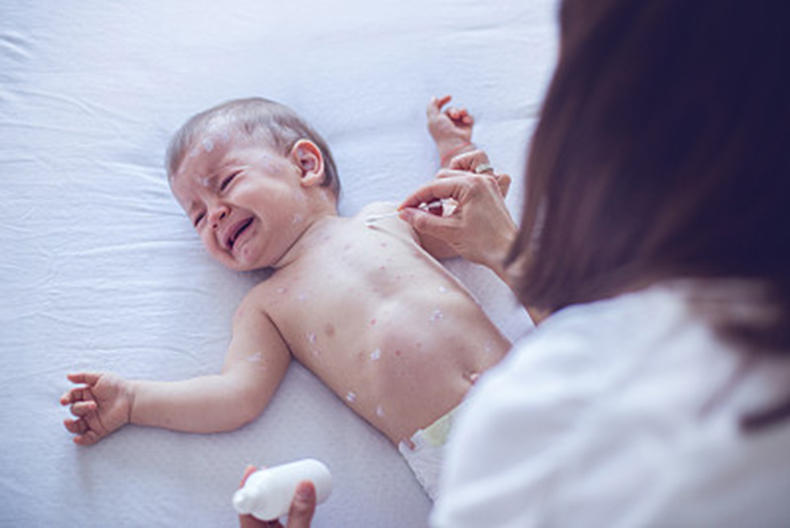 一个月宝宝蛋白质过敏怎么办,婴儿蛋白质过敏如何喂养