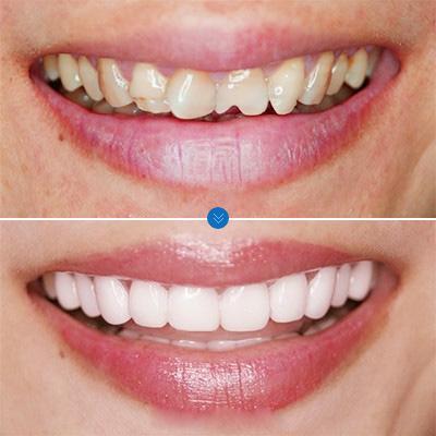 嗑瓜子把牙齿磕裂缝了怎么办,瓜子牙出现小裂痕怎么办