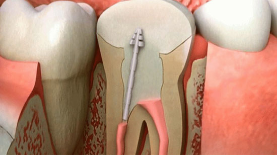 根管治疗后需要套冠么,根管治疗后冠修复一般多少钱