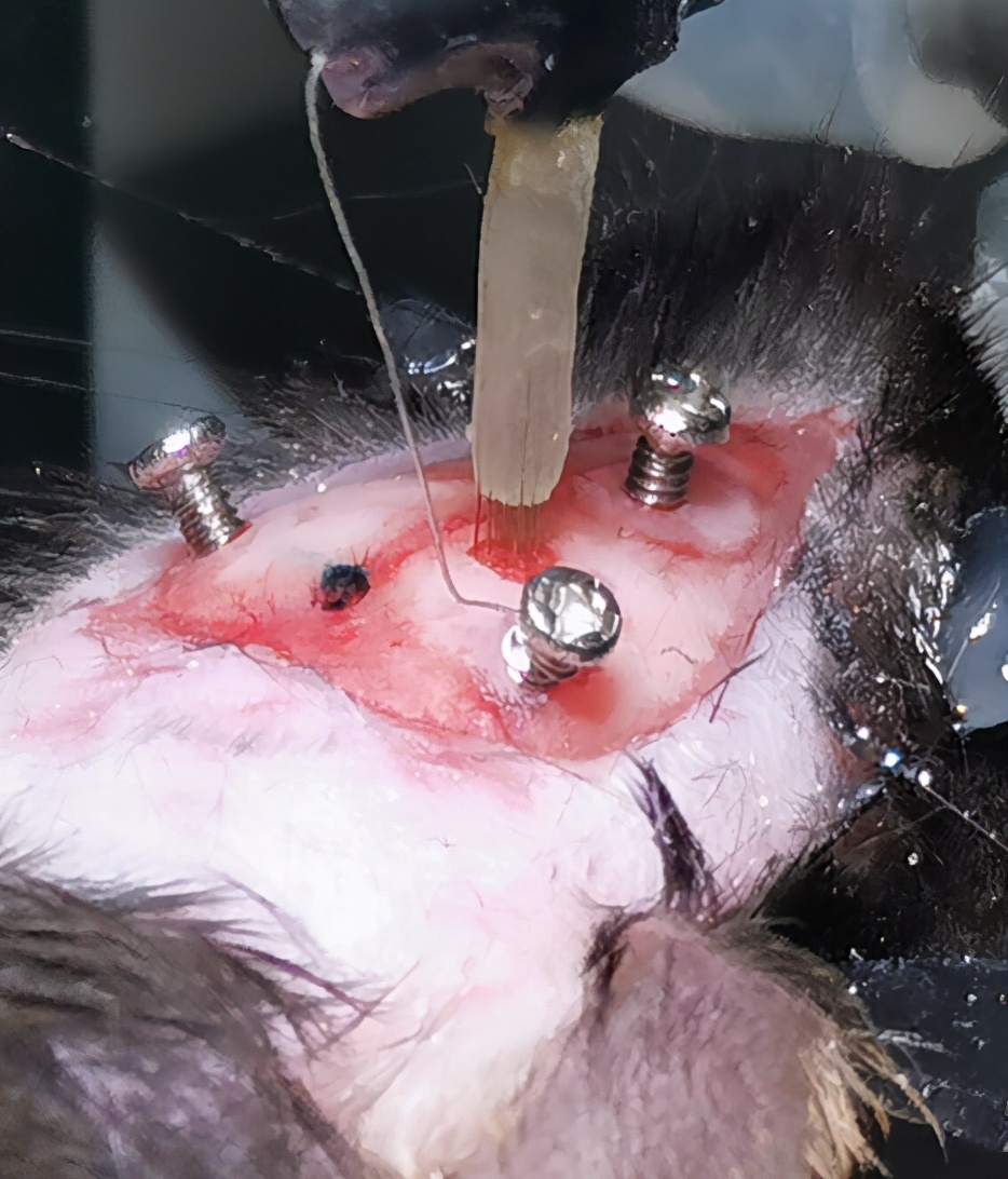 晶体植入手术的分享,可调微丝阵列电极