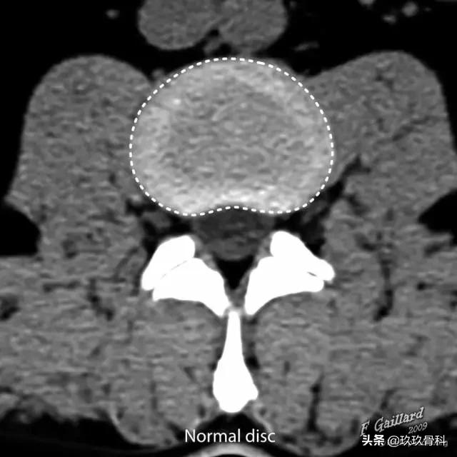 图解腰椎间盘突出,椎间盘髓核膨出图