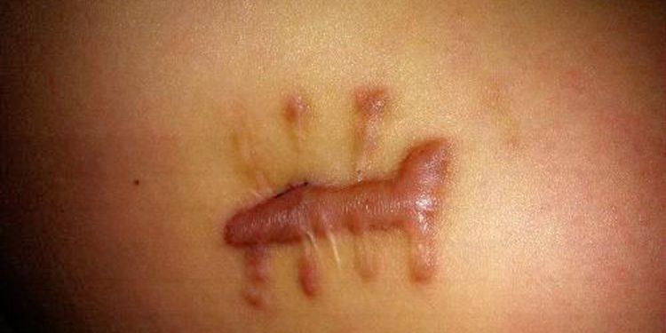 祛除凸疤最有效的方法,脸上有增生凸疤怎么办