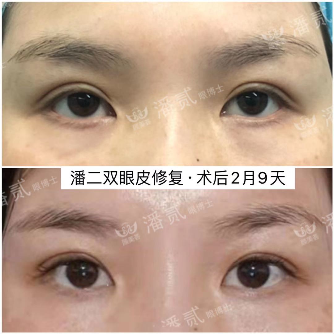 10年前做过韩式双眼皮,做过韩式三点双眼皮还能开眼角吗