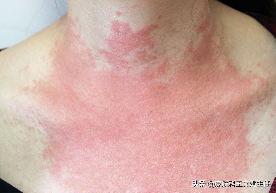 夏天皮肤病的预防,夏天常见皮肤病诊断及用药图谱