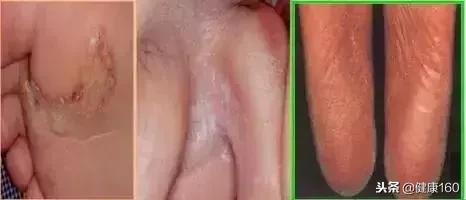 那些被你忽略的细节都是隐患,脚气是怎么传染的全过程