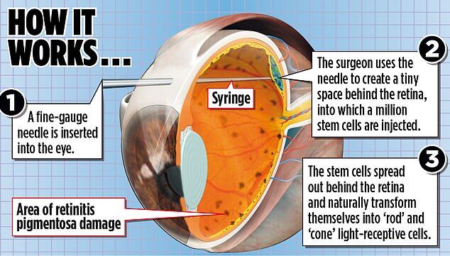 向眼球注射干细胞英创新疗法或能治愈这种失明