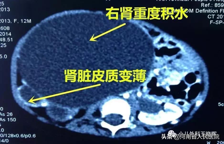 肾积水手术需要插几天尿管,宝宝重度肾积水