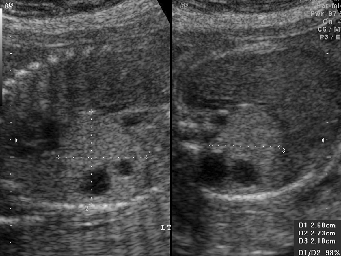 超声检查可以看到胎儿肺部吗,针对性胎儿心脏超声检查
