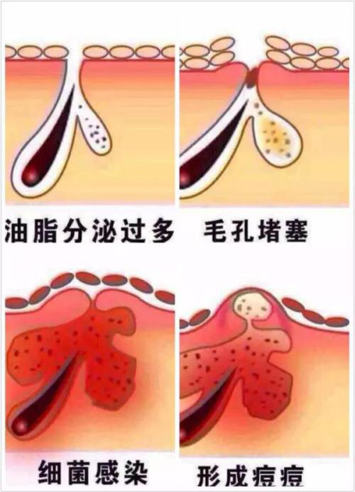 暗疮泛红用碘伏能消炎吗,起脓疮型痘痘用什么药