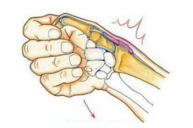 关节封闭针怎么打,关节疼打封闭针视频