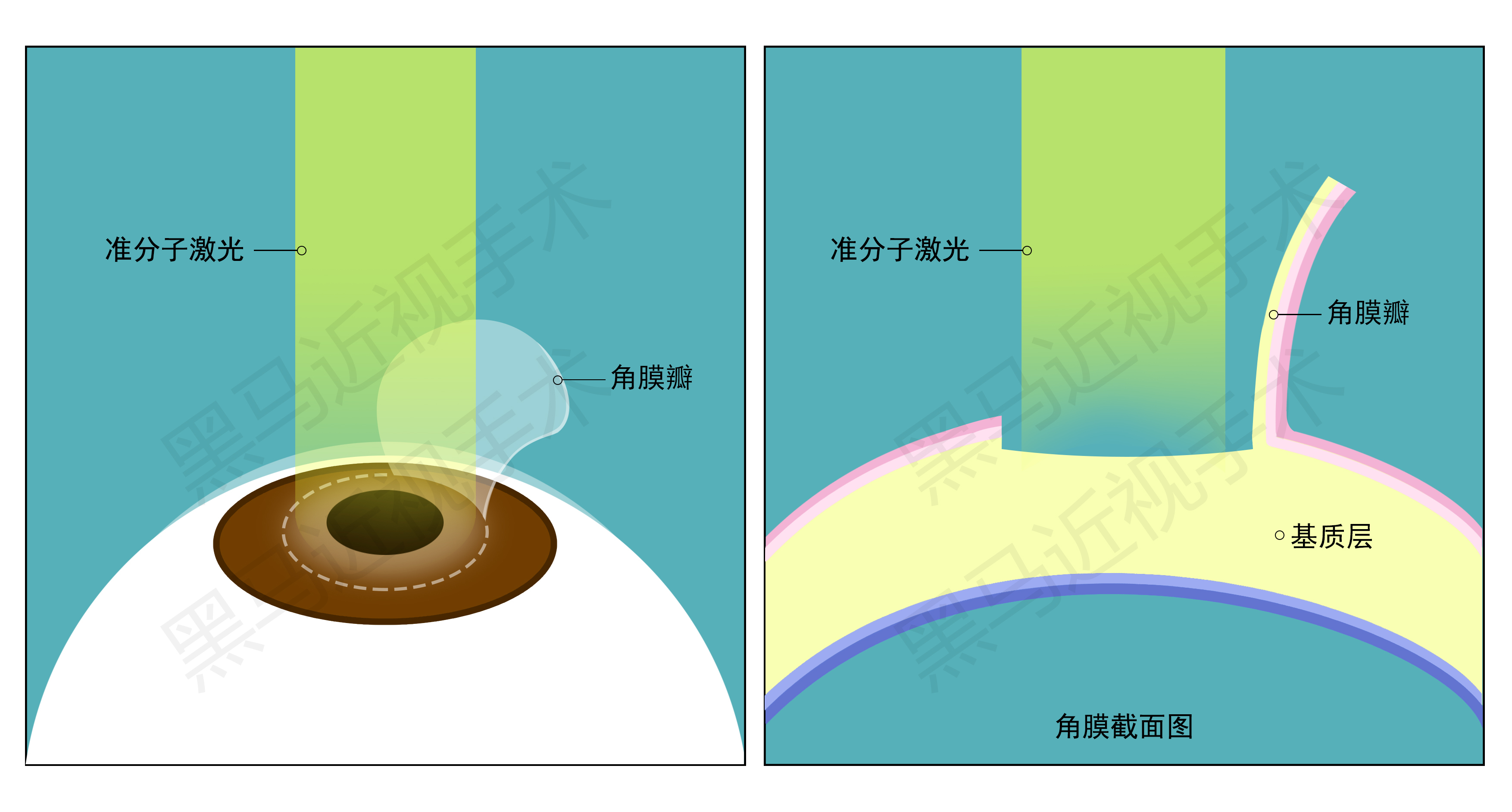 激光近视矫正手术有什么后遗症,激光治疗近视安全啊有没有后遗症