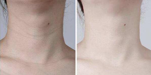 面部抗全面衰强攻略