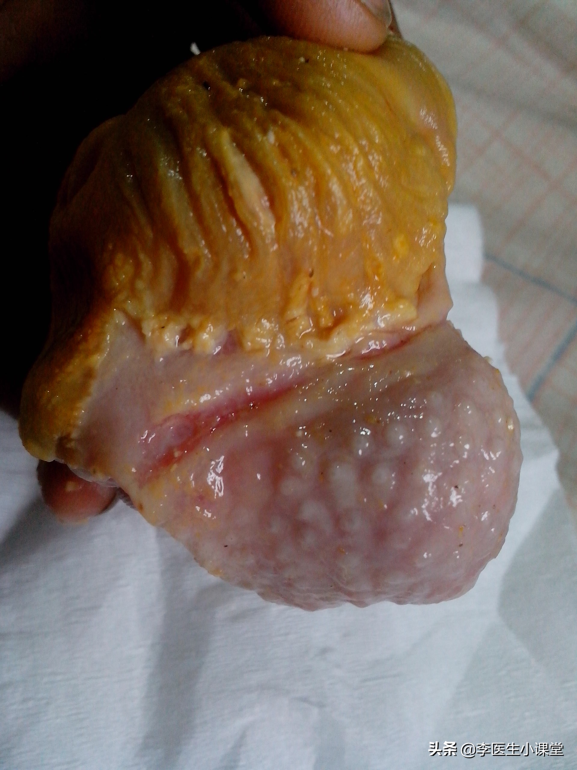 萎缩性胃炎到胃癌经历几步,慢性萎缩性胃炎复发变胃癌吗