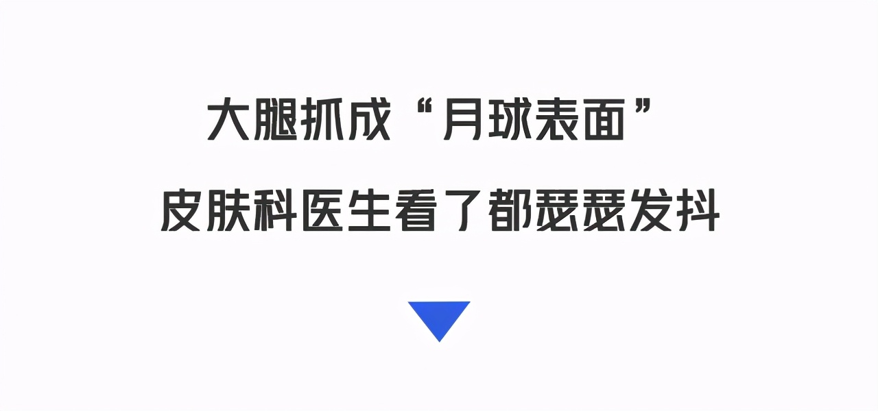 得了湿疹,得了湿疹身上的伤就没好过