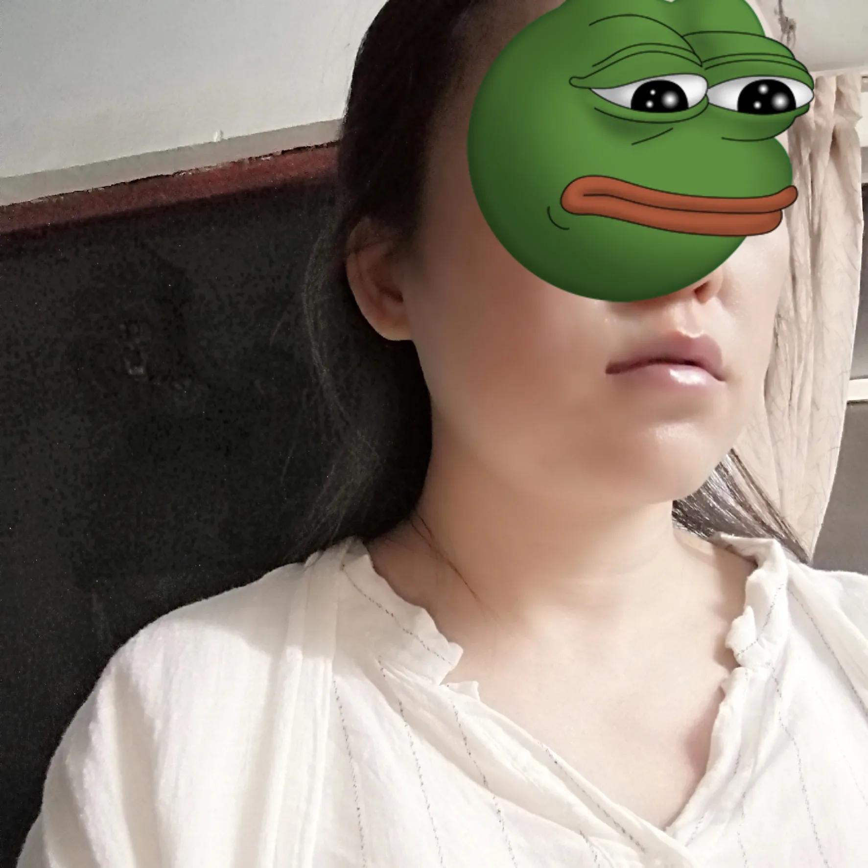 亲身经历了拔尽头牙,两颗门牙种植牙的惨痛经历