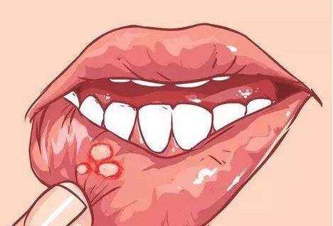 宝宝口腔溃疡缺什么,小孩脾胃积热口腔溃疡食疗