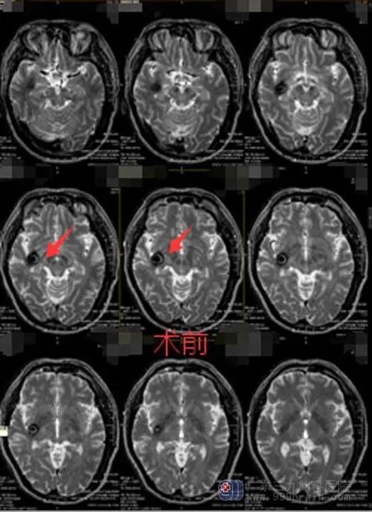 脑干海绵状血管瘤手术后头晕,海绵状脑血管瘤会造成头晕吗