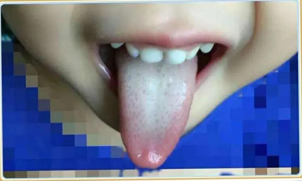 娃舌苔好厚,孩子舌苔特别厚