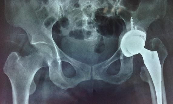 关节置换后关节感染,关节置换手术后真菌感染后果