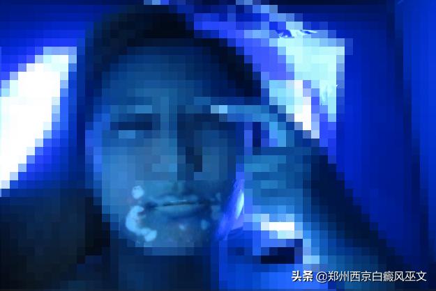 白癜风治疗前后对比图,白癜风治疗中为什么白斑更加白呢