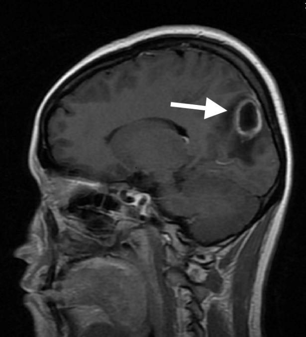 青春痘不要乱挤不然会出事,痘痘不能随便抠