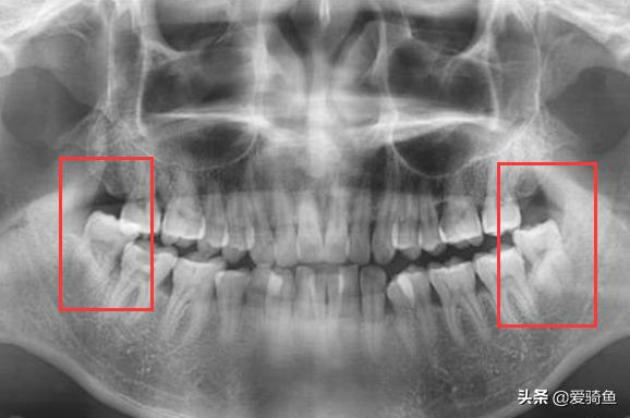 拔一颗长出来的智齿大概要花多少,拔一颗智齿前前后后花了快两千