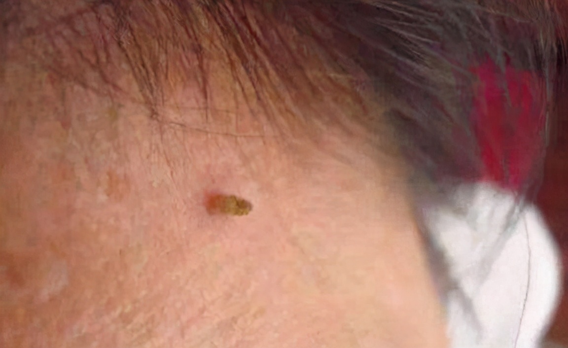 脖子腋下腹股沟长小肉粒怎么去除,腋下脖子上长小肉粒是什么原因