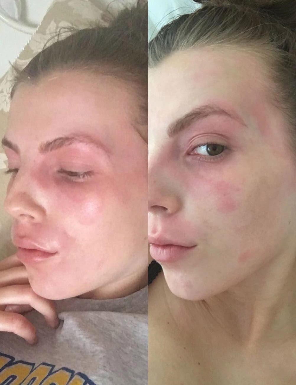 11岁女孩全身长湿疹是怎么回事,33岁女子身上长湿疹一查尽是癌