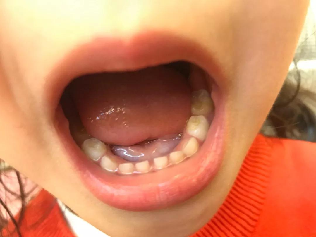 3岁宝宝牙齿需要做什么,三岁宝宝治疗牙齿过程